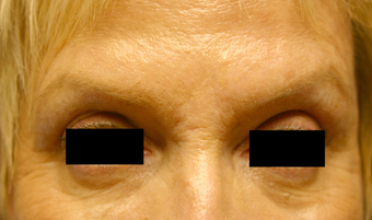 Botox & Restylane - Glabella after 410982
