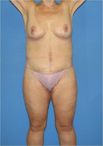 Body Lift & Breast Lift after 529675