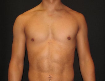Pectoral Implants before 421489