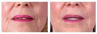 Restylane for wrinkles and marionette lines before 6266