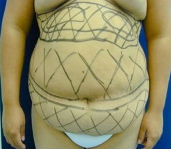 Liposculpture for stomach before 374835