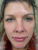 Hydrelle Injection for Treating Laugh Lines or Nasolabial Folds after 196055