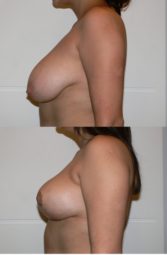 Breast Reduction 427690