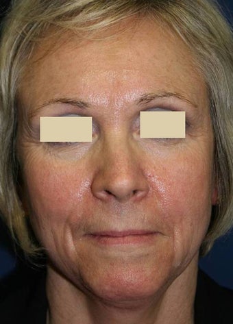 Sculptra Liquid Lift before 137157