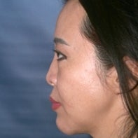 Asian Rhinoplasty before 448665