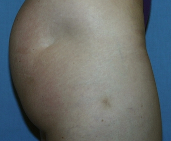 Fat Transfer before 275689