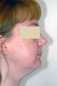 Neck Liposuction before 87336