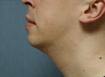 chin augmentation after 408390