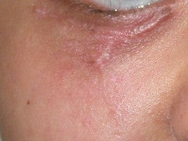 Scar Treatment before 555507