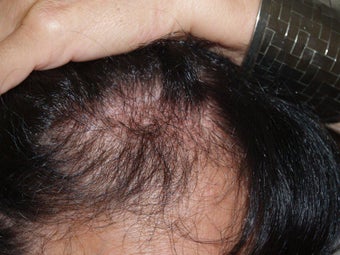 Hair Transplant into Scar 336980