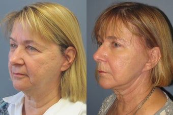 Lite Lift, upper and lower eyelid lift, liposuction of the neck, blue peel before 523514