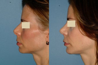 Rhinoplasty - Secondary before 127505