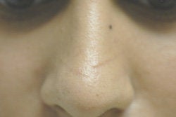Scar Removal after 145655