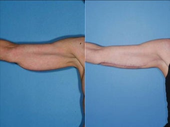 Brachioplasty - Upper Arm Lift before 131872