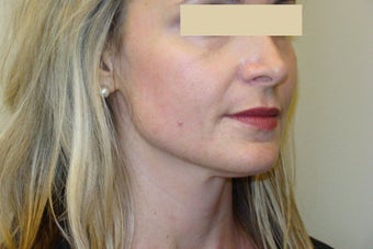 Active FX Laser Resurfacing after 132711