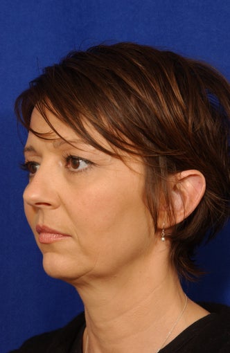 Neck-lace with anatomic chin implant before 279557