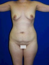 Tummy Tuck (Abdominoplasty), Breast Enhancement before 429758