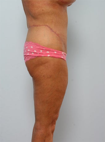 Body Lift after 260127