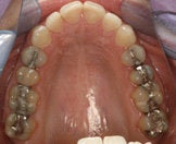 CEREC Restorations before 345561