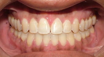 Adult Orthodontic Treatment (case #3KE) after 224691