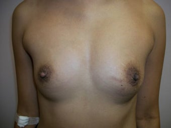 Breast Augmentation before 258582