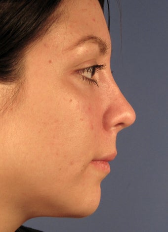 Revision Rhinoplasty 410615