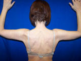 Arm Lift Surgery after 133861
