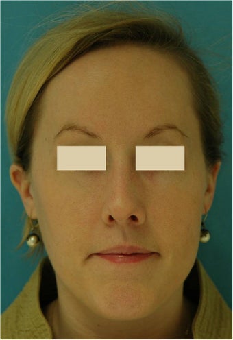 Rhinoplasty, Septoplasty after 124594