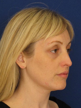 Bilateral Upper Blepharoplasty and Lower Blepharoplasty with TCA Chemical Peel, performed in the office under oral sedation w before 249709