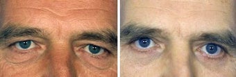 Blepharoplasty before 643229