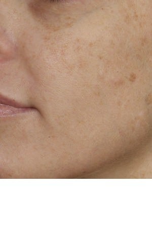 Alexandrite and IPL (Intense pulsed light) treatment before 119757