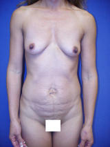 Tummy Tuck Surgery (Abdominoplasty) with Breast Augmentation before 121180