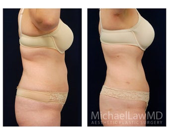 Liposuction 397198