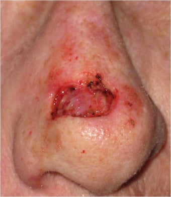 Mohs surgery defect of dorsum of the nose before 82513
