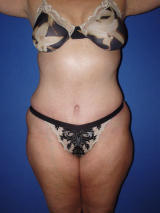 Abdominoplasty surgery after 119463