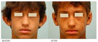 Otoplasty (Cosmetic Ear Pinning) before 136398