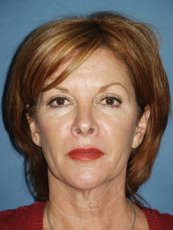 Facelift, Endoscopic Browlift, Upper and Lower Blepharoplasty, Perioral Dermabrasion before 248923