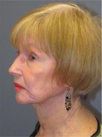 Neck Lift, Platysmaplasty 634745