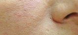 Perlane for cheeks after 93360