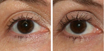 Latisse Before & After before 352672