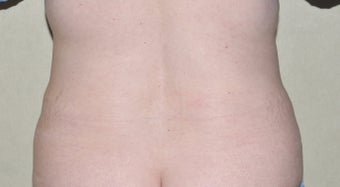 Liposuction after 293854
