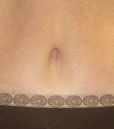 Belly Button after Tummy Tuck Surgery after 123332