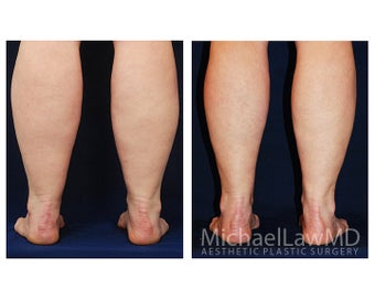 Liposuction 499133