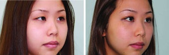 Double eyelid surgery suture 548949