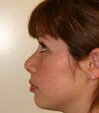 Revision Rhinoplasty after 222492