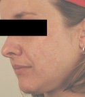 Acne Scar Removal after 88865