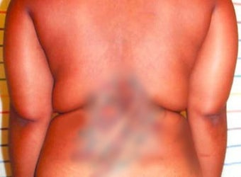 Smart Lipo before 125008