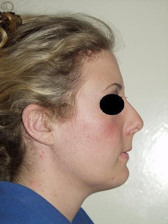 Chin implant after 209458