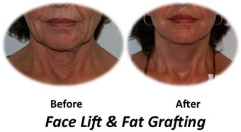 Facelift before 70155