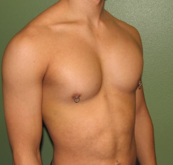 Pectoral Implants 421489